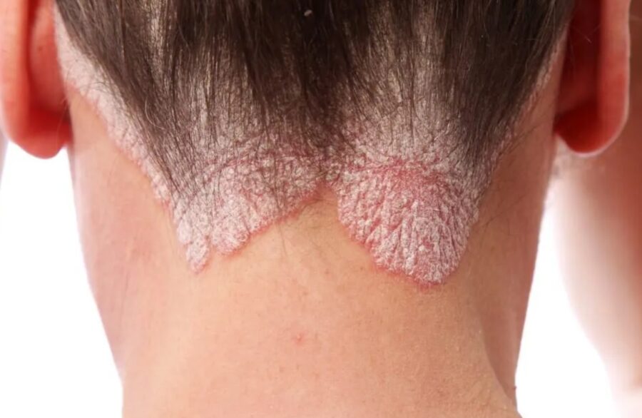 Early Signs of Scalp Psoriasis