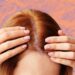 Early Signs of Scalp Psoriasis: How to Recognize and Manage Them