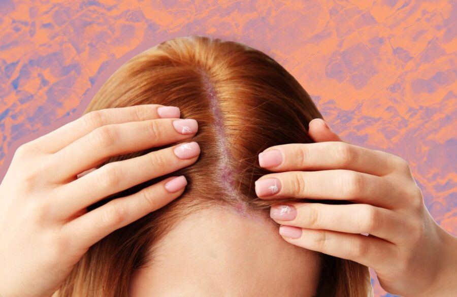Early Signs of Scalp Psoriasis